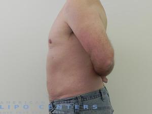 abdomen laser liposuction before and after