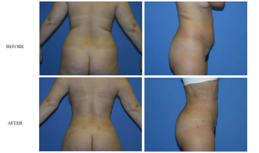 American Lipo Center Brazilian Butt Lift