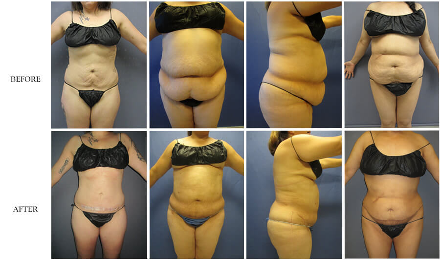 American Lipo Center Mini Tummy Tuck