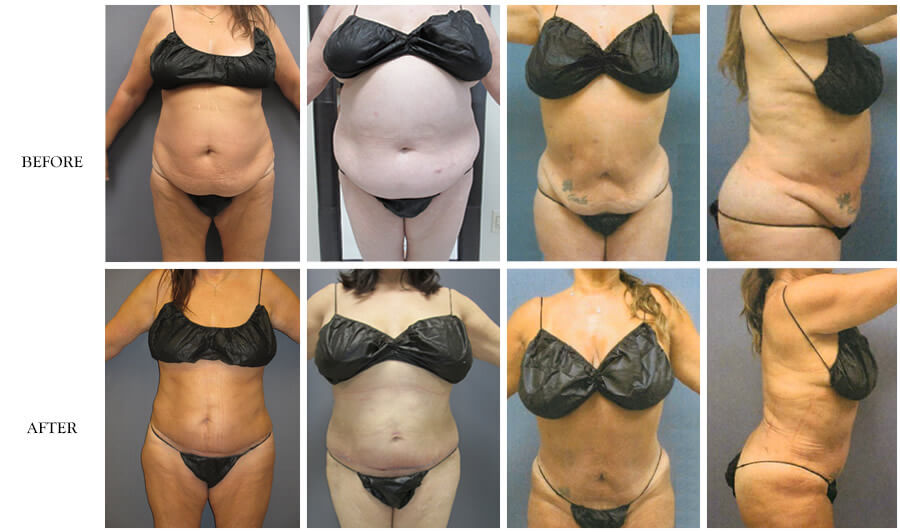 American Lipo Center Mini Tummy Tuck